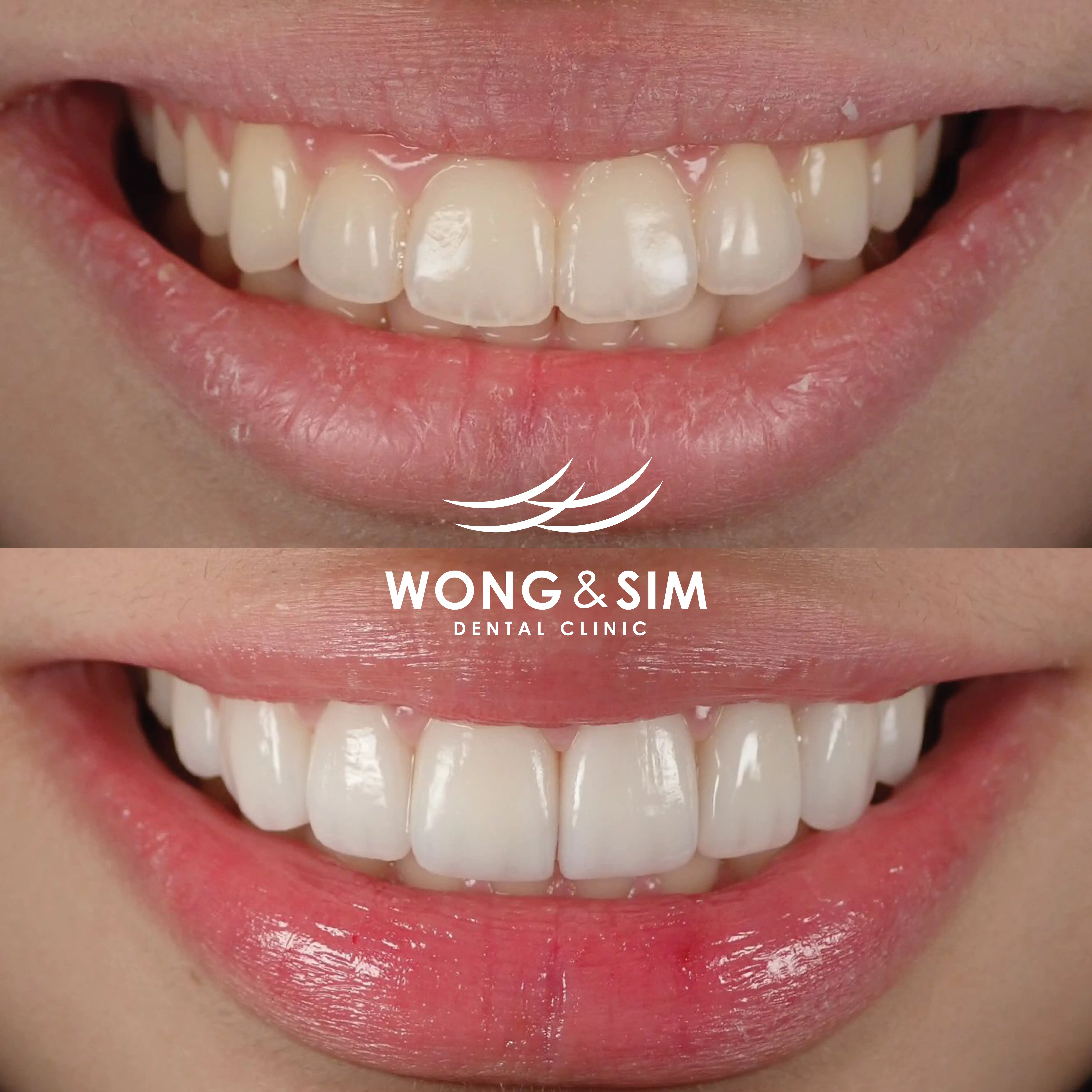 Patient 1 - Smile Makeover Before and After